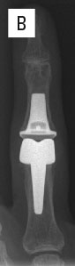 Figure 6. b. Frontalrøntgen etter 5 år viser velintegrerte protesekomponenter.
